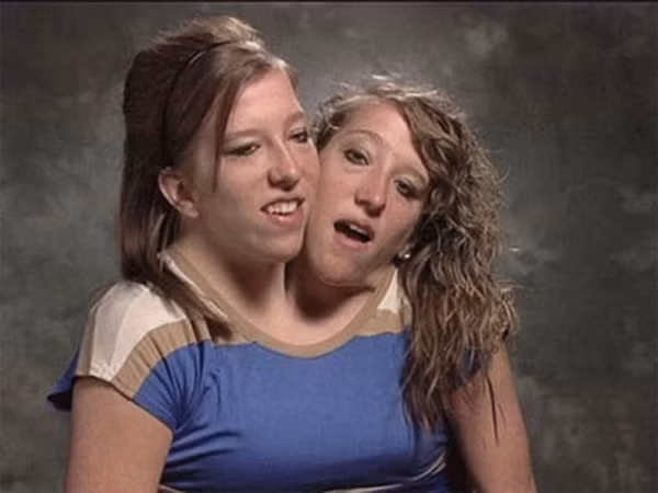 Đây chính là trường hợp người có 2 đầu nổi tiếng nhất thế giới đó là Abigail Loraine Hensel và Brittany Lee Hensel. Sinh ra với cùng một cơ thể nhưng họ có 2 tâm hồn khác nhau.