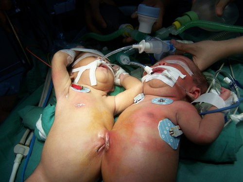 Mới đây nhất, ngày 1/7 tại Bệnh viện Đa khoa tỉnh Kon Tum, cũng đã cuất hiện một cặp song sinh là hai bé gái dính nhau phần bụng, cặp song sinh này chào đời ở hoàn cảnh cực kì nguy hiểm bởi các bé ra đời bằng phương pháp đẻ thường.