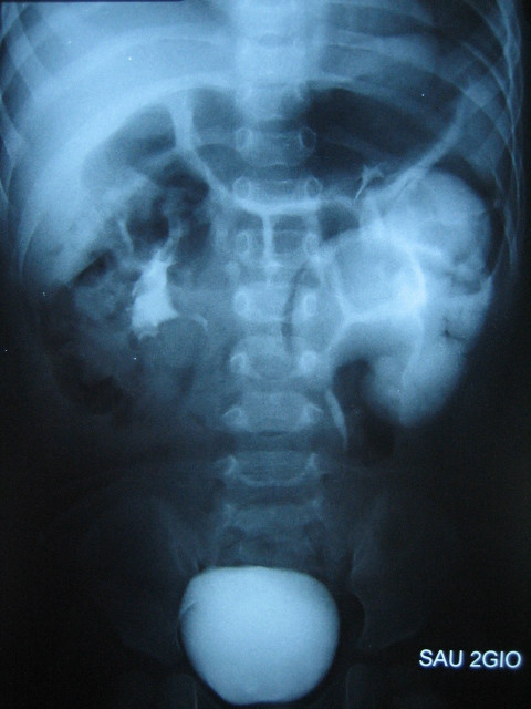 Hình ảnh hai quả thận nhưng có chung 1 niệu quản của bé V.