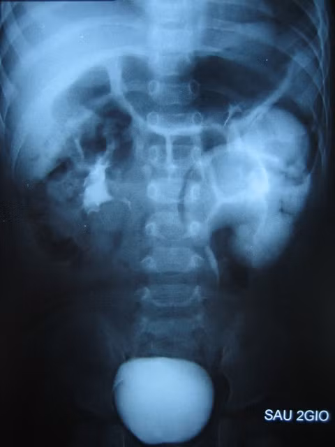 Hình ảnh hai quả thận nhưng có chung 1 niệu quản của bé V.