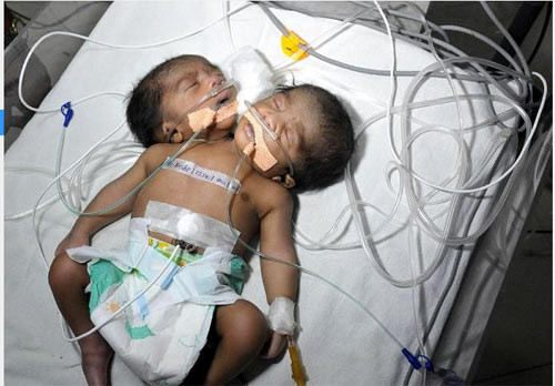 Theo bác sĩ S.D. Sharma, giám đốc bệnh viện J.K. Lone, những cặp song sinh hai đầu (Hội chứng Dicephalic Parapagus) đều chết ngay sau khi chào đời và phần lớn những ca được ghi nhận đều mang giới tính nữ. Hiện cặp song sinh trên vẫn chưa được đặt tên chính thức. Theo ước lượng tỷ lệ song sinh dính nhau là 1/100.000 các trẻ sơ sinh và tỷ lệ sống sót ở những trường hợp này là 1/10.000.