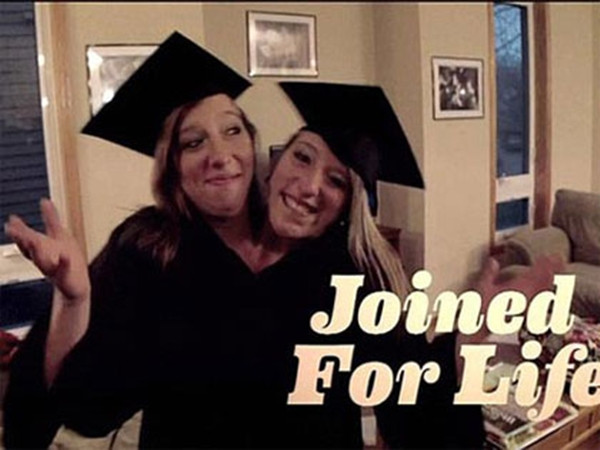 Abigail Loraine Hensel và Brittany Lee Hensel sinh ngày 7/3/1990 tại tiểu bang Minnesota (Mỹ). Đầu của Abigail nằm bên phải còn Brittany nằm ở bên trái. 2 chị em có 2 xương sống và nối với nhau ở khung chậu, họ có 2 gan, 2 trái tim, 3 quả thận, 2 dạ dày, 4 phổi, và 2 cánh tay (1 cánh tay phát triển không hoàn toàn ở giữa cơ thể đã bị cắt bỏ khi họ còn nhỏ).