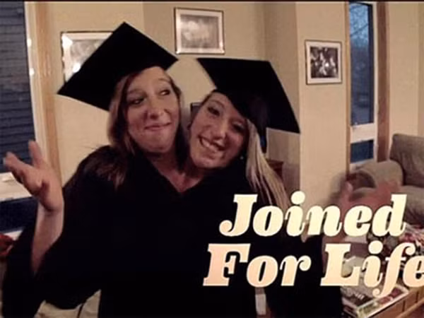 Abigail Loraine Hensel và Brittany Lee Hensel sinh ngày 7/3/1990 tại tiểu bang Minnesota (Mỹ). Đầu của Abigail nằm bên phải còn Brittany nằm ở bên trái. 2 chị em có 2 xương sống và nối với nhau ở khung chậu, họ có 2 gan, 2 trái tim, 3 quả thận, 2 dạ dày, 4 phổi, và 2 cánh tay (1 cánh tay phát triển không hoàn toàn ở giữa cơ thể đã bị cắt bỏ khi họ còn nhỏ).