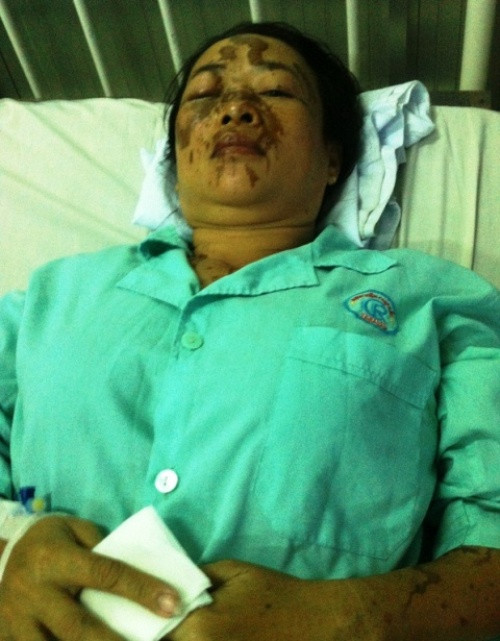 Bà Tăng Thúy Hà cũng bị phỏng nặng.