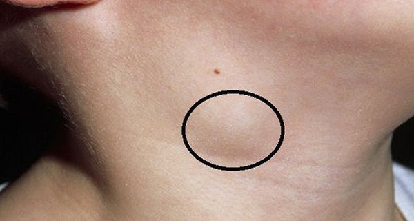 7 triệu chứng rõ mồn một của K tuyến giáp, nhiều người ở giai đoạn nặng 7 trieu chung ro mon mot cua K tuyen giap, nhieu nguoi o giai doan nang