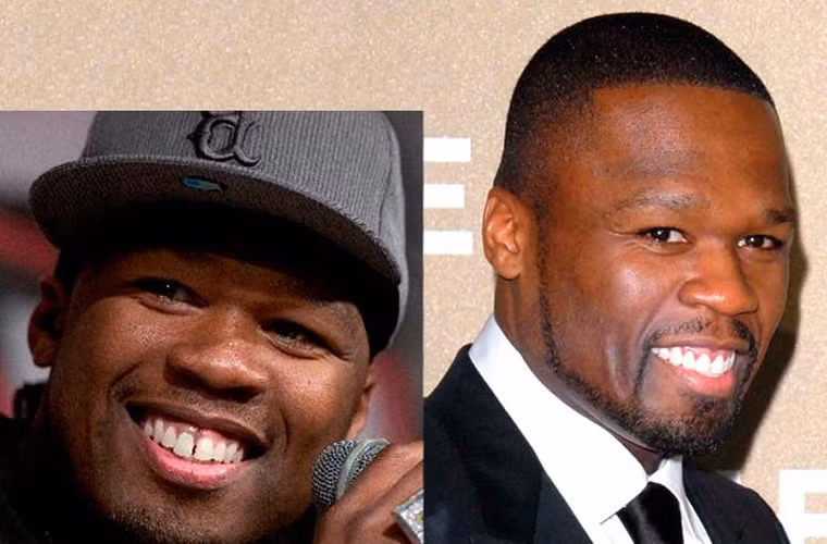 Rapper 50 Cent rút ví hơn 50.000 USD để sở hữu nụ cười tự tin và tươi tắn như bây giờ.