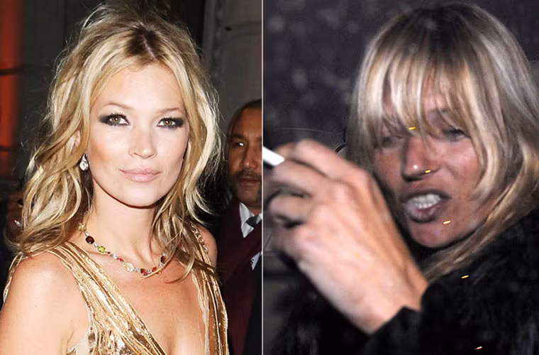 Ma túy đã khiến da và răng của Kate Moss xấu thảm hại. Scandal nghiện heroin của siêu mẫu Anh quốc bị phát hiện vào năm 2005 đã khiến cô bị mất rất nhiều hợp đồng với các thương hiệu lớn như Burrberry, H&amp;M và Chanel.
