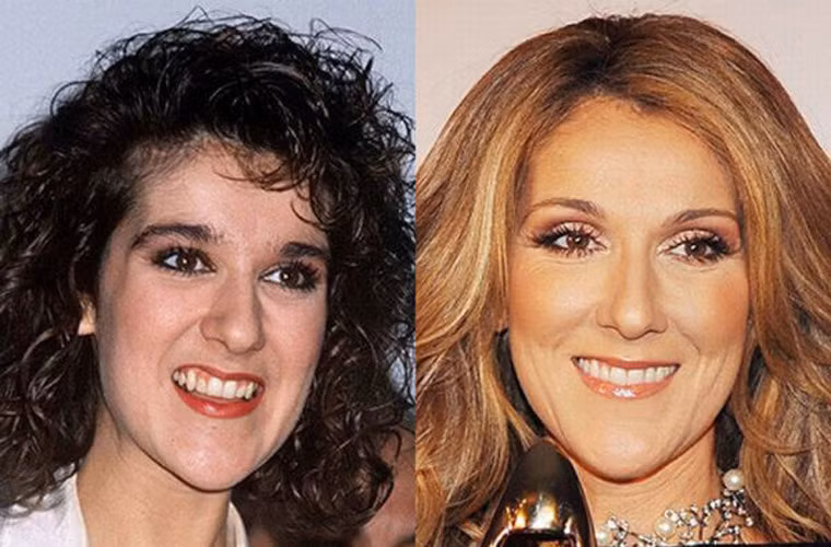 Diva Celine Dion nổi tiếng với giọng hát cao, mượt mà, nhưng cô phải tốn khá nhiều tiền chỉnh hàm răng nhọn cha sinh mẹ đẻ.