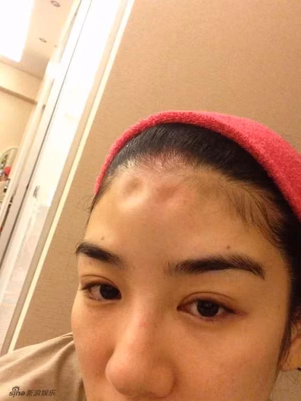 Huỳnh Dịch chụp lại bức ảnh trán cô bị lồi lõm sau trận đòn của chồng.