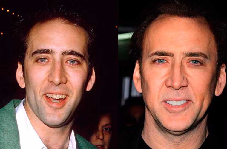 Hàm răng trước kia của Nicolas Cage ố vàng khiến nụ cười của anh bị mất điểm ghê gớm.