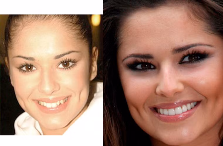 Nữ ca sĩ xinh đẹp Cheryl Cole từng vật vã với hàm răng lô nhô của mình lúc mới vào nghề hát, và bác sĩ nha khoa đã giúp cô có nụ cười ngọt ngào, xinh xắn thế này.