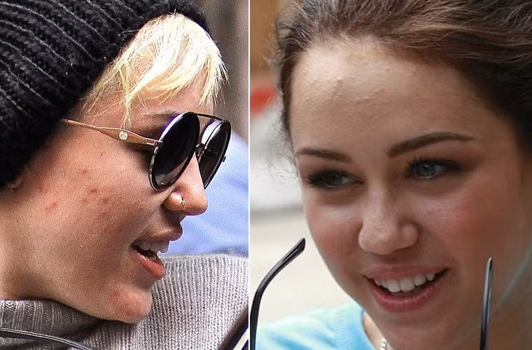 Trái với khuôn mặt xinh xắn của Miley Cyrus, làn da của cô lại quá tệ.