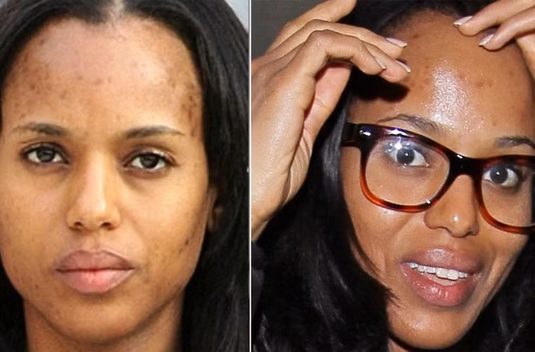 Trên mặt Kerry Washington vô số những đốm nâu, hậu quả sau những lần nặn bóp mụn.