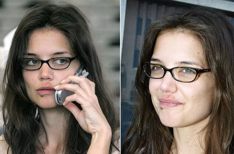 Katie Holmes xấu xí với những nốt mụn to tướng xung quanh miệng.