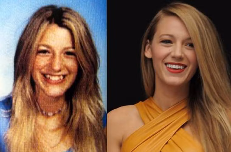 Khi chưa nổi tiếng, nhan sắc của Blake Lively chỉ xếp ở hạng trung bình vì hàm răng khểnh xấu xí. Hình ảnh của cô hiện tại từ nét mặt cho tới mái tóc, thân hình, đều không còn có điểm gì để chê nữa.