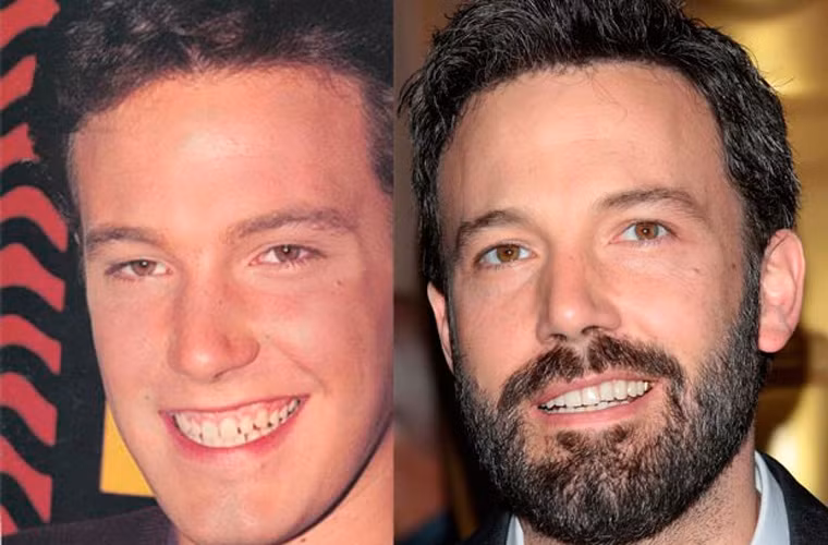 Nam diễn viên kiêm đạo diễn Ben Affleck phải bọc sứ để kéo dài răng ra, không còn bị hở lợi khi cười nữa.