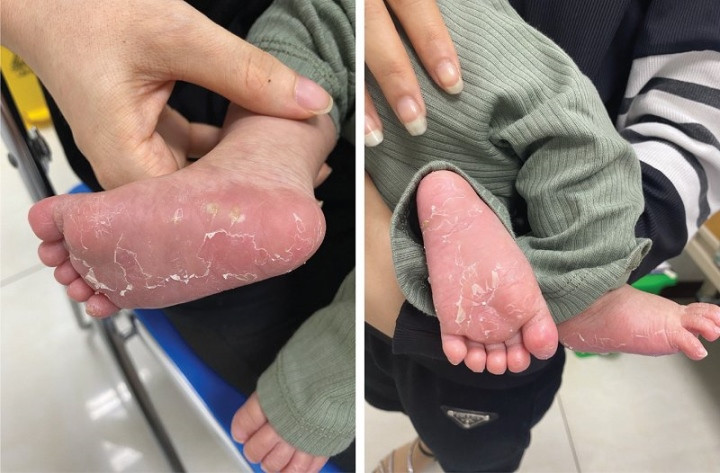 Trẻ 46 ngày tuổi bị giang mai Tre 46 ngay tuoi bi giang mai