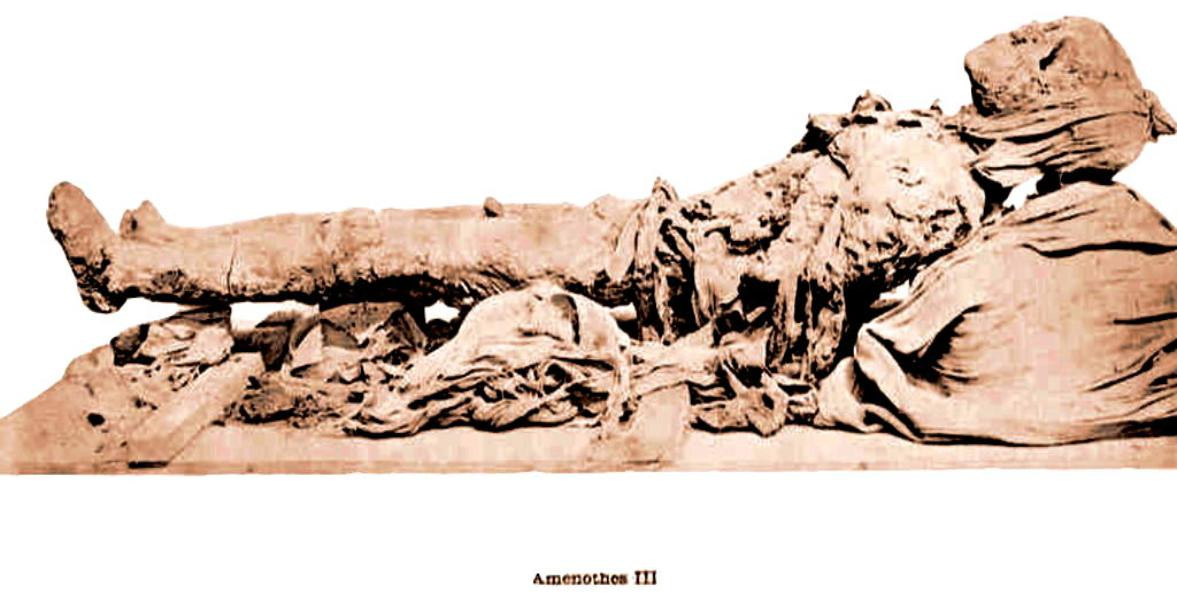 Cụ thể, ông đã bị viêm khớp và mắc chứng béo phì ở mức độ nghiêm trọng, khiến việc đi lại và thực hiện các hoạt động thường ngày gặp nhiều khó khăn.