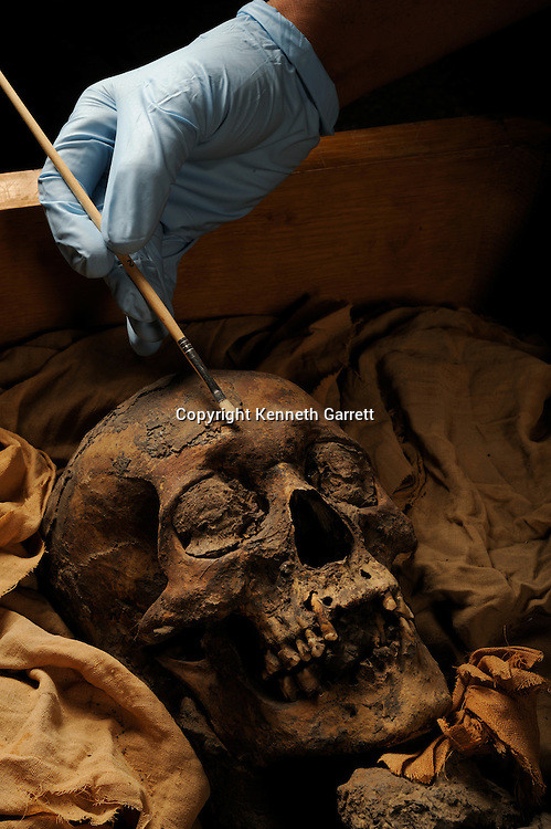 Ngoài ra ông cũng có những ổ áp xe lớn ở răng, khiến việc ăn uống trở thành một cực hình.