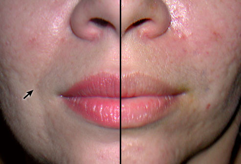 Trước và sau khi độn thẩm mỹ: Trong hình là kết quả một ca tiêm axit hyaluronic, kết quả có thể kéo dài trong 9 tháng hoặc lâu hơn. Tiêm collagen có thể cho kết quả khác nhưng cần lặp lại 3-6 tháng/ lần. Tiêm nếp nhăn bằng các tế bào chất béo thường cho kết quả vĩnh viễn. Một chất cũng mang lại kết quả lâu dài là polymethylmethacrylate hoặc PMMA., trước đây dùng trong phẫu thuật xương, nay được chấp nhận trong phẫu thuật thẩm mỹ.