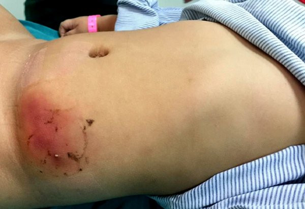 Vùng mụn mủ bị áp xe lan rộng, chứa nhiều dịch có mùi.