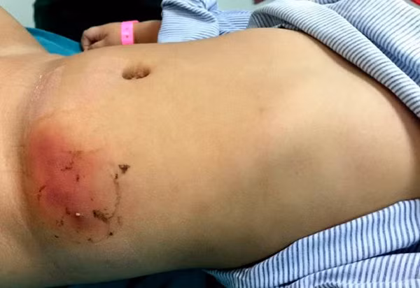 Vùng mụn mủ bị áp xe lan rộng, chứa nhiều dịch có mùi.