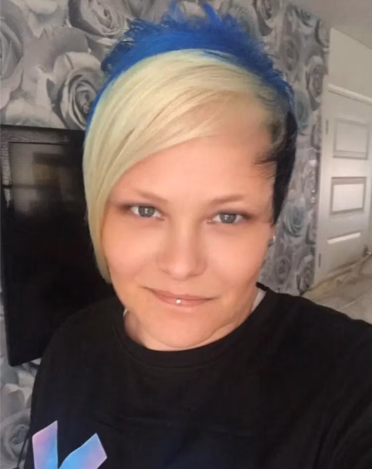 Nguoi phu nu phai phau thuat 55 lan vi mot vet xuoc