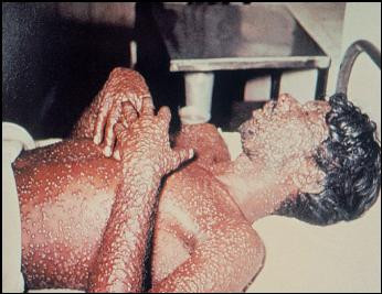 Nó được nước Anh phát triển đầu tiên vào những năm 1950 tại phòng thí nghiệm Porton Down. Năm 1958, công thức của nó được trao cho Mỹ trong một thỏa thuận để đổi lấy những bí mật khoa học của vũ khí nhiệt hạch. Nó được Mỹ sản xuất trên quy mô lớn vào năm 1961. VX là một loại chất hóa học lỏng, giết chết nạn nhân bằng enzym exetylcholinesterase với độ mạnh bằng 10 lần của sarin. Ảnh: Nạn nhân khí VX.