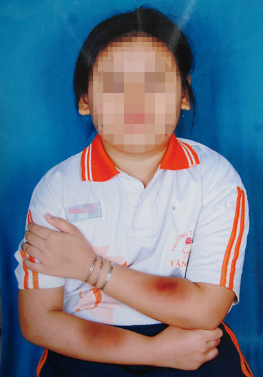 Bé A. bị bầm tím hai bên tay. Ảnh: Gia đình cung cấp.