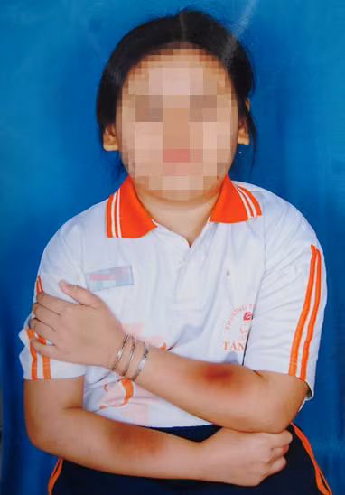 Bé A. bị bầm tím hai bên tay. Ảnh: Gia đình cung cấp.