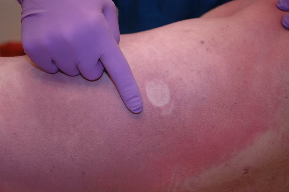 Tụ máu tử thi là giai đoạn tiếp theo. Máu tụ lại ở những điểm thấp nhất của cơ thể thành những vết máu bầm tụ lại dưới da.