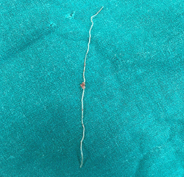 Phát hiện ký sinh trùng trong khối u trên má sau khi muỗi đốt Phat hien ky sinh trung trong khoi u tren ma sau khi muoi dot