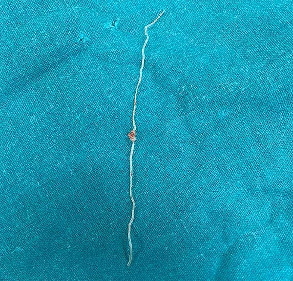 Phat hien ky sinh trung trong khoi u tren ma sau khi muoi dot