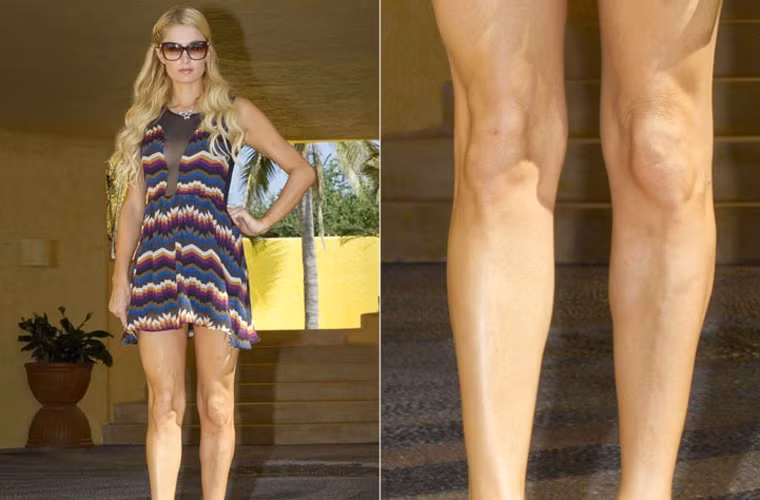 Đôi chân dài của Paris Hilton bị mất điểm bởi đôi củ lạc hai bên đầu gối.