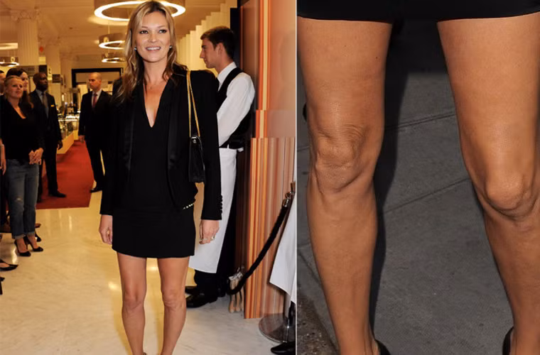 Hai đầu gối của Kate Moss là bộ phận già nua nhất trên cơ thể cô khi phần da ở đó càng ngày càng chảy nhão.