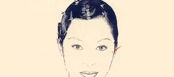 Sau not ruoi vuong phu tren co the, nam vuong vo, nu vuong chong