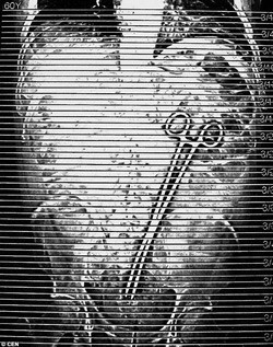 Chiếc kẹp dài tới 38cm nằm trong bụng ông Pohl trong nhiều tuần sau khi thực hiện thủ tục thông một đoạn ruột bị tắc.