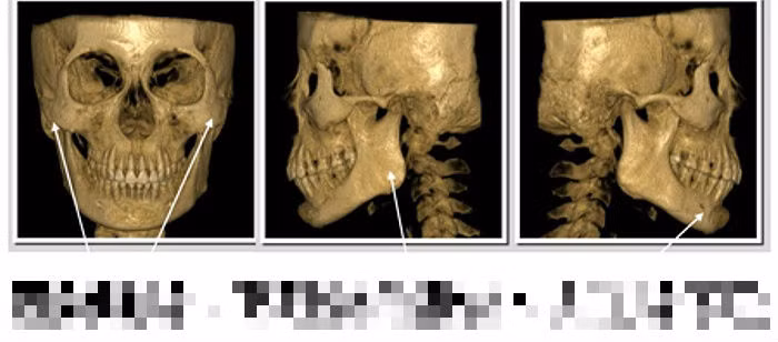 Những hình ảnh minh họa hộp sọ và xương mặt trước khi phẫu thuật thẩm mỹ.