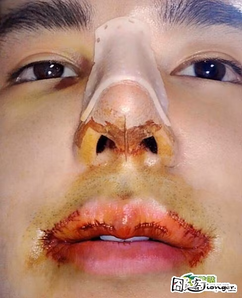 Đôi môi chảy máu đau đớn, mũi sưng tấy sau khi tiến hành các thủ thuật dao kéo.