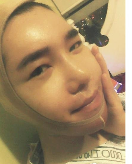 Khuôn mặt sưng vù phải nẹp băng.