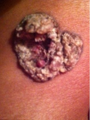 Cô nói "Các bác sĩ da liễu đã bị sốc khi nhìn thấy vết phồng rộp của tôi. Họ chưa bao giờ nhìn thấy phản ứng dị ứng như này trước đây".