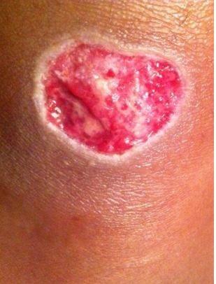 Vào tháng 6/2013, sau khi tình hình nhiễm trùng da trở nên đáng sợ, cô Nicola đã nhờ đến sự trợ giúp của các bác sĩ tại bệnh viện St Thomas, London.