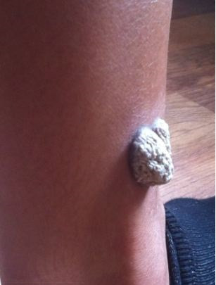 6 tuần sau khi xăm hình, phần da thịt nơi cô xăm màu bị phồng rộp nghiêm trọng, cô không thể mang giày dép hay ngủ một giấc trọn vẹn.