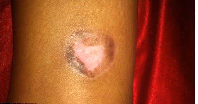 Hiện tại, cô Nicola có vết sẹo 4cm trên chân. Dù vết sẹo vẫn còn nhưng cô Nicola cảm thấy vô cùng thoải mái khi vết phồng rộp cũng như sự đau đớn đã biến mất hoàn toàn.