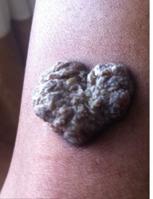 Khi tìm đến trung tâm xăm hình trước đó, các chuyên gia xăm hình tại đây đã khuyên cô dùng kem sát trùng. Tuy nhiên, mỗi ngày trôi qua, vết sưng càng trở nên trầm trọng.