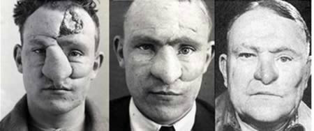 Người đầu tiên phẫu thuật mũi. Chiến sĩ William M. Spreckley đã trở thành người đầu tiên được thực hiện phẫu thuật cấy ghép mũi. Tháng 1/1917, chiến sĩ Spreckley nhập viện trong tình trạng bị thương do súng ở mũi. Hơn 3 năm rưỡi sau đó, chiến sĩ Spreckley mới được xuất viện với diện mạo mới.