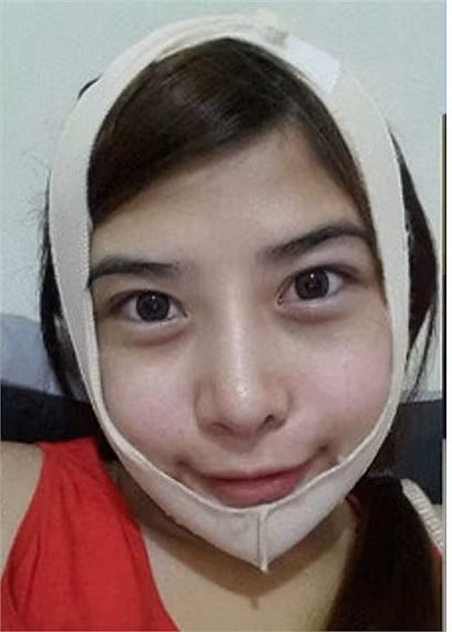 Sau 2 tuần, khuôn mặt đã đỡ sưng hơn đáng kể