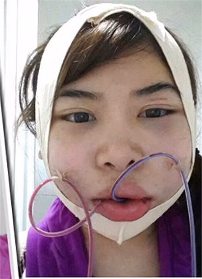 Ống dẫn truyền nước cho cơ thể vì hệ quả phẫu thuật khiến cô đau đớn không thể há nổi miệng.