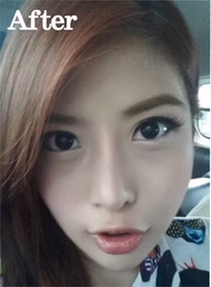 Tuy nhiên, phải mất từ 1 đến 1,5 tháng để cằm có thể hoạt động tự nhiên hơn.