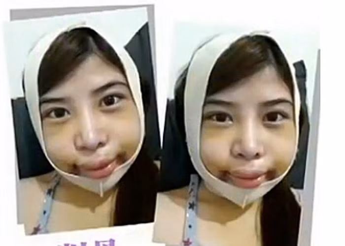 Khuôn mặt vẫn sưng tấy như quả bóng.